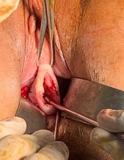 Ginecólogo oncólogo realizando un curetaje endocervical con una cureta de novack, luego de una conización.