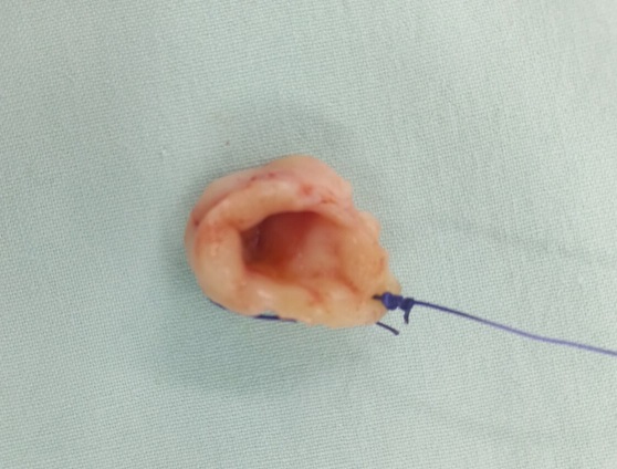 fragmento en forma de cono del cuello uterino